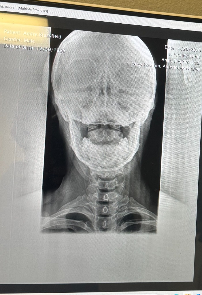 A-P Cervical X-Ray Mechanism Diagram