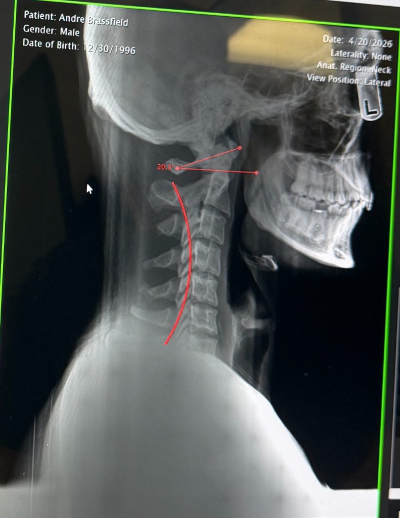 Lateral Cervical X-Ray